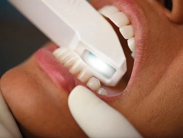 Intraoralscanner in Köln