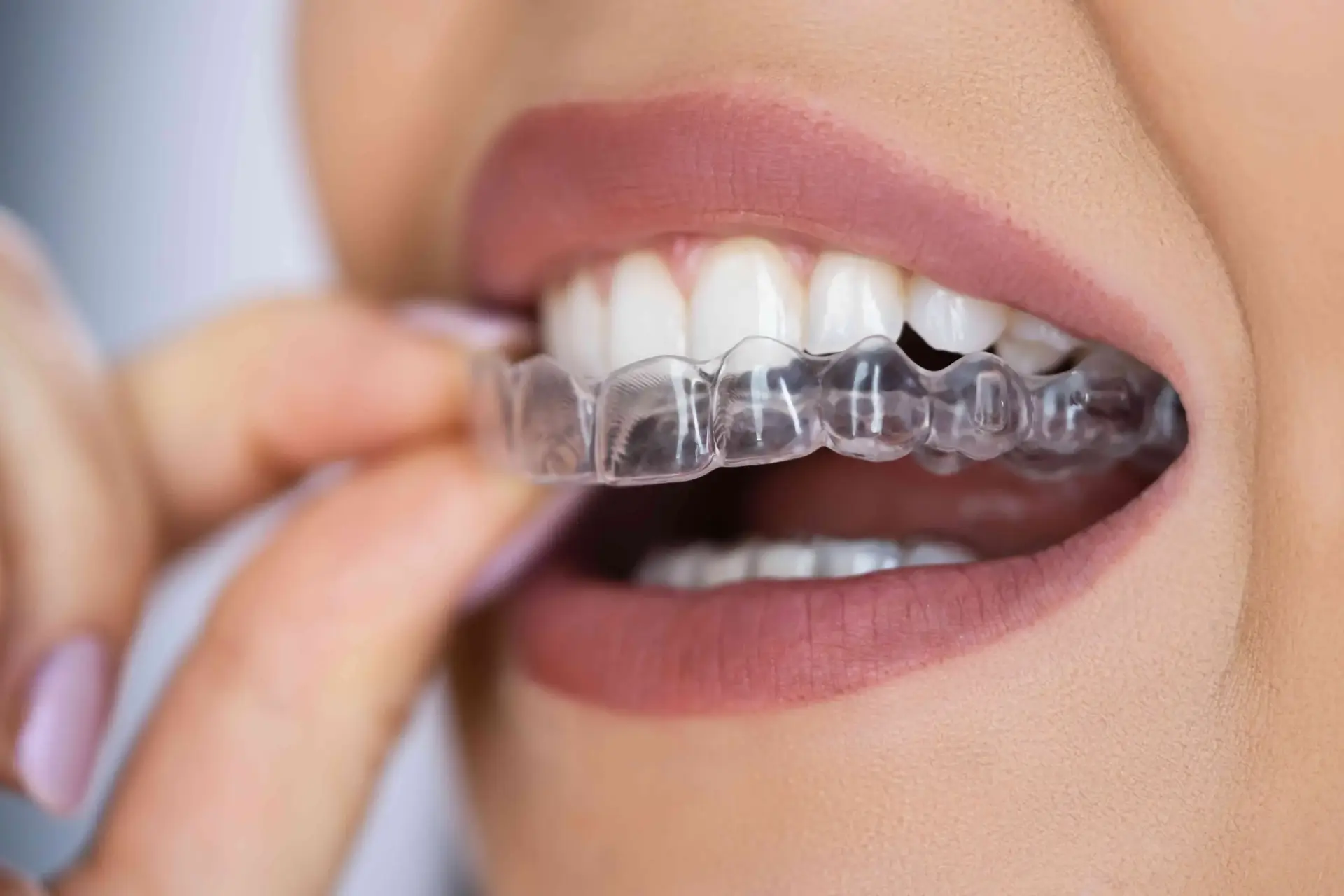 Invisalign alligner bei topDxentis Cologne