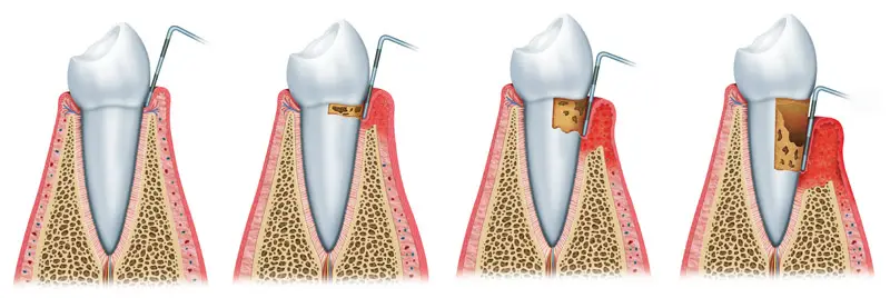 Umweltzahnmedizin topDentis Cologne: Der Zahnhalteapperat