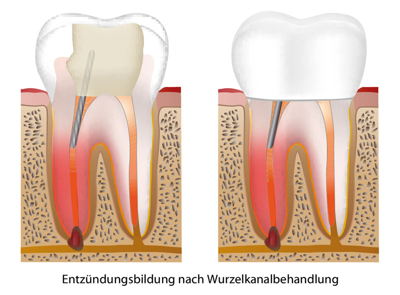 Wurzebehandlung Entzündung Zahnarzt