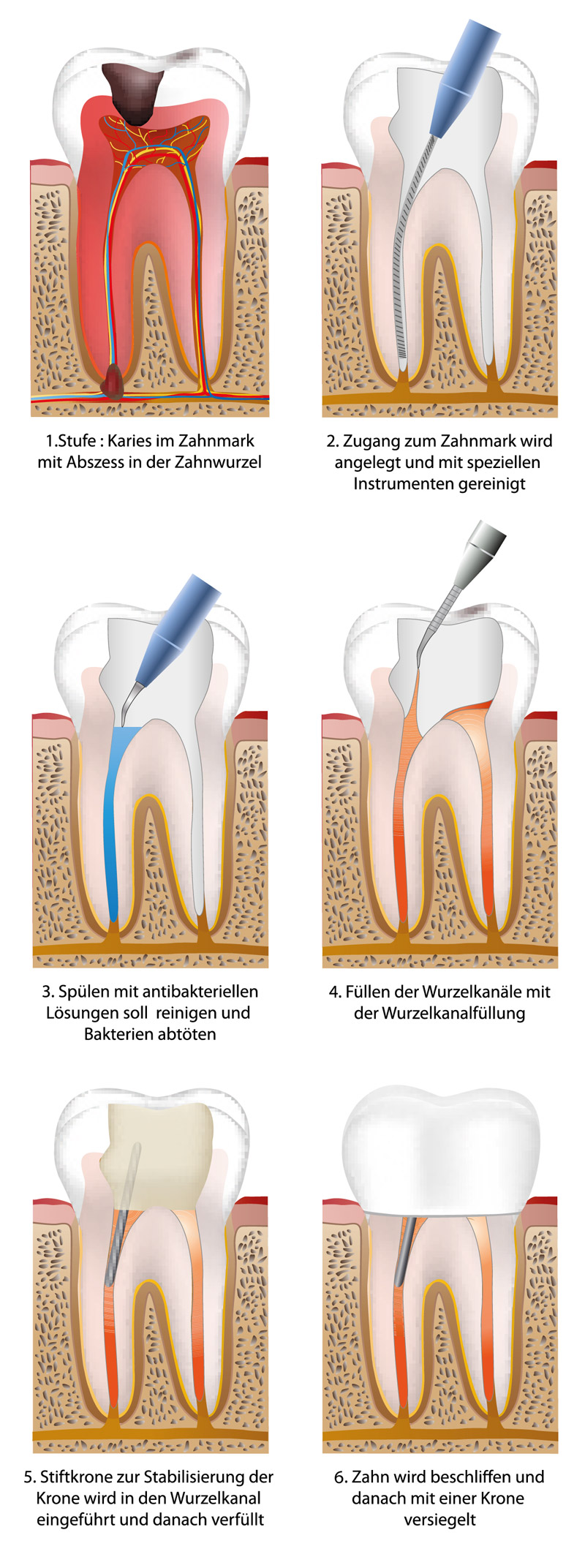 Wurzelbehandlung in Köln - Ablauf beim Zahnarzt erklärt