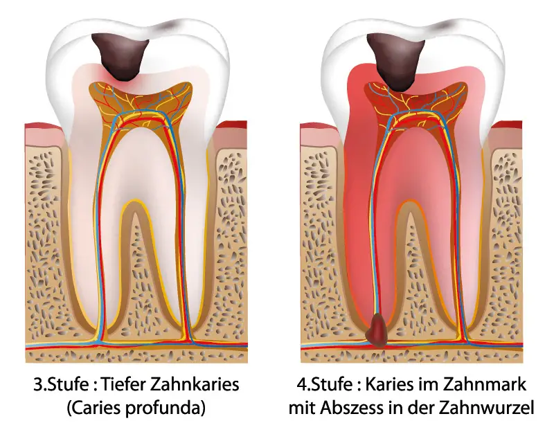 Zahnerkrankungen: Entwicklung einer Karies Stufe 2
