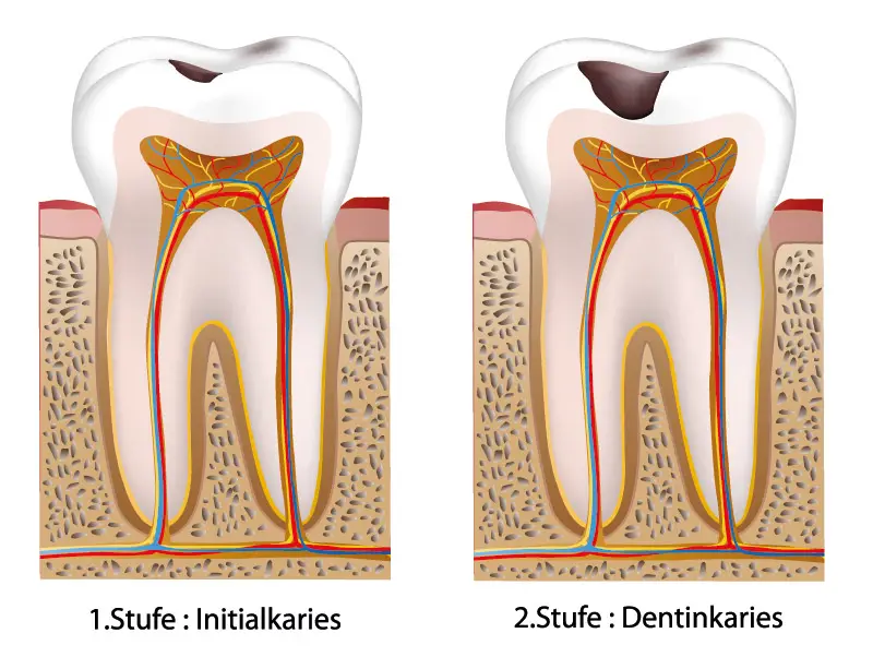 Zahnerkrankungen: Entwicklung einer Karies
