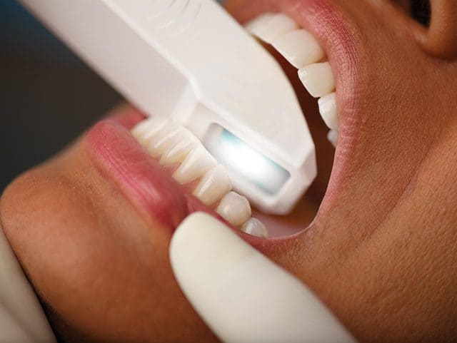 Intraoralscanner beim Zahnarzt – moderne digitale Abformung bei topDentis Cologne