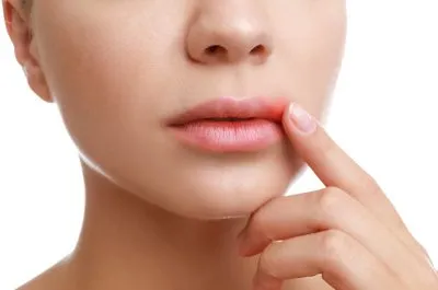 Topdentis Cologne Zahnarzt Koeln Anwendung Detallaser Herpes
