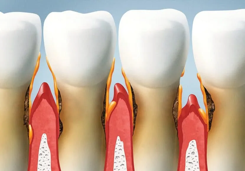 Topdentis Cologne Zahnarzt Koeln Zahnreihe Mit Fortgeschrittener Parodontitis