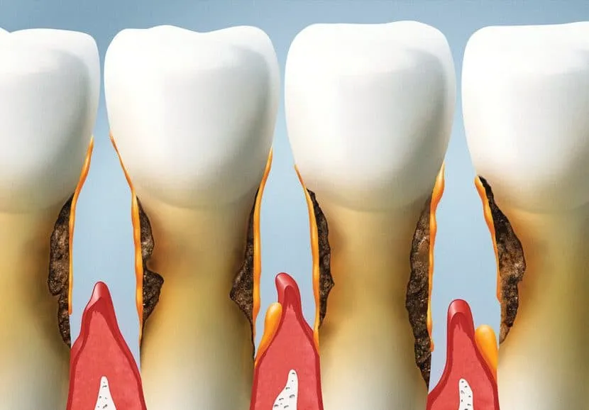 Topdentis Cologne Zahnarzt Koeln Zahnreihe Mit Starker Parodontitis